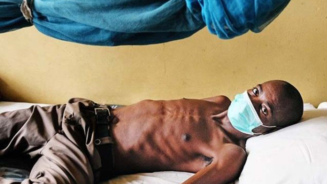 Tuberculosis: 41,000 People At Risk In Benue State