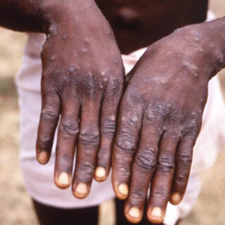 Nigeria Records 24 New Cases Of Monkeypox