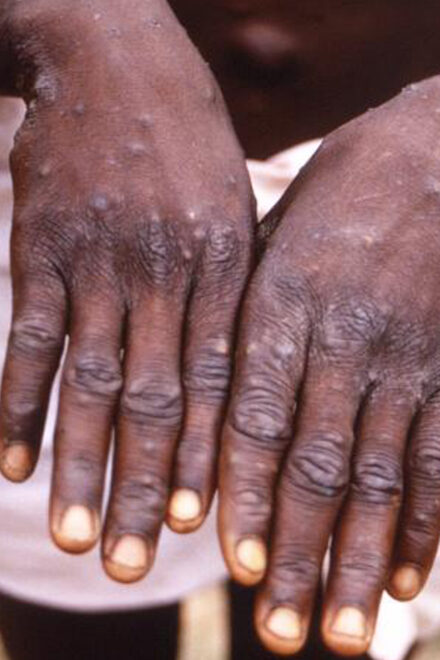 Nigeria Records 24 New Cases Of Monkeypox