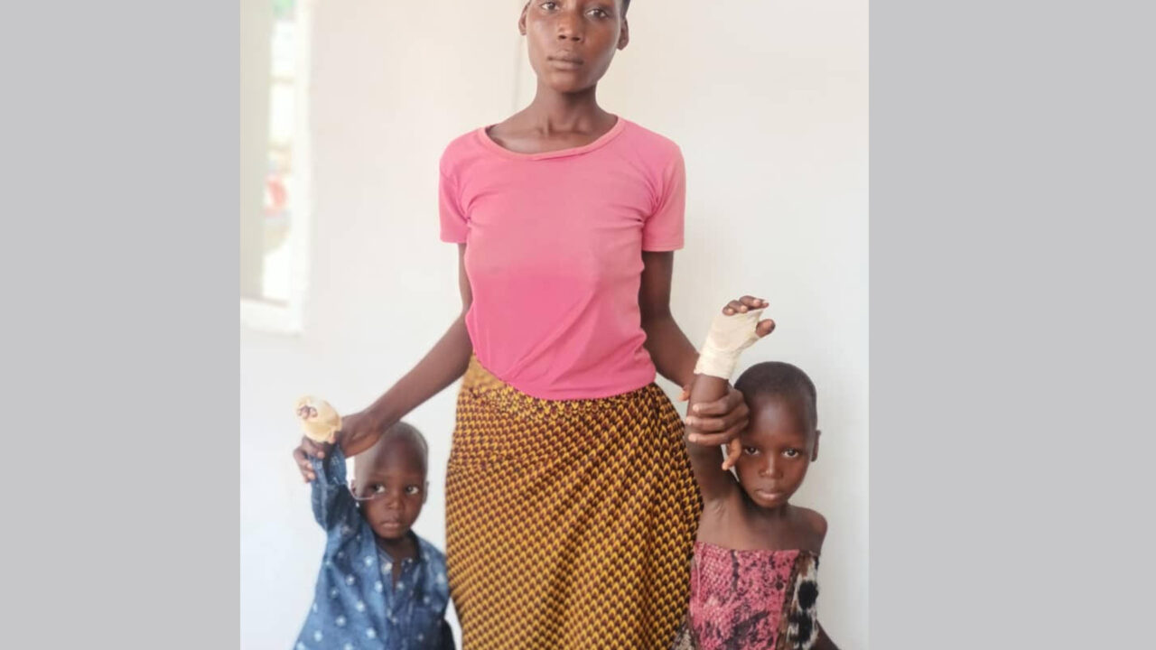 Step Mother Burns Hands of Two Minors for Eating Dad’s Meal
