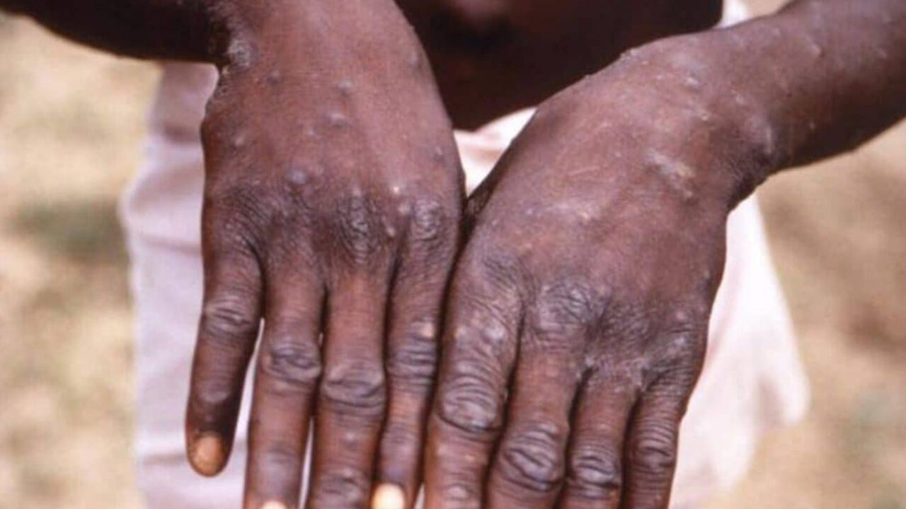 Nigeria Has 40 Confirmed Cases Of Mpox – NCDC